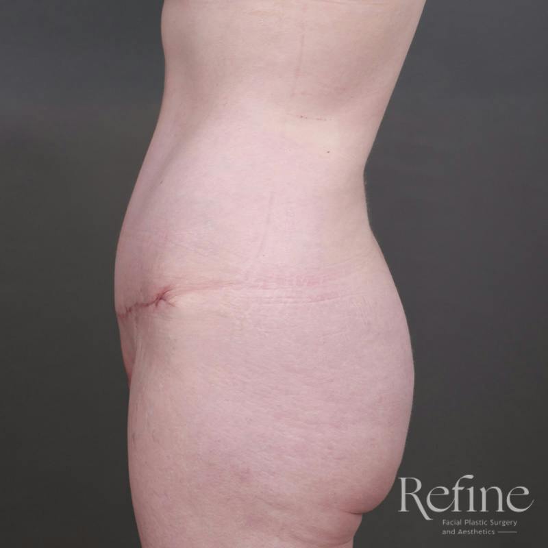 Tummy Tuck Before & After Gallery - Patient 234953 - Image 10