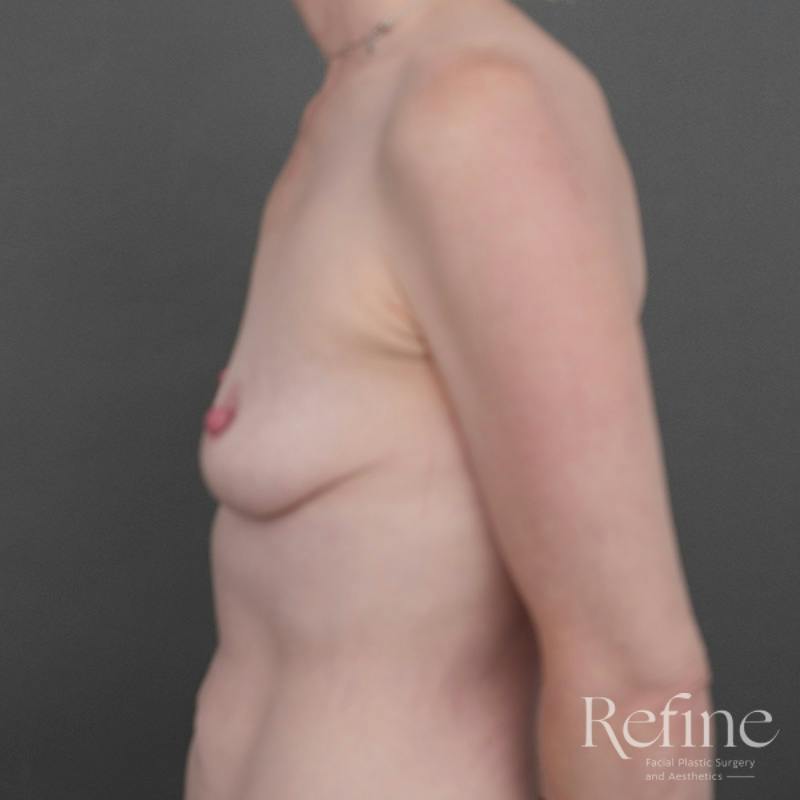 Breast Augmentation with Lift Before & After Gallery - Patient 623630 - Image 9