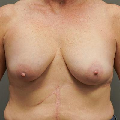 Breast Augmentation Revision Before & After Gallery - Patient 126364 - Image 1