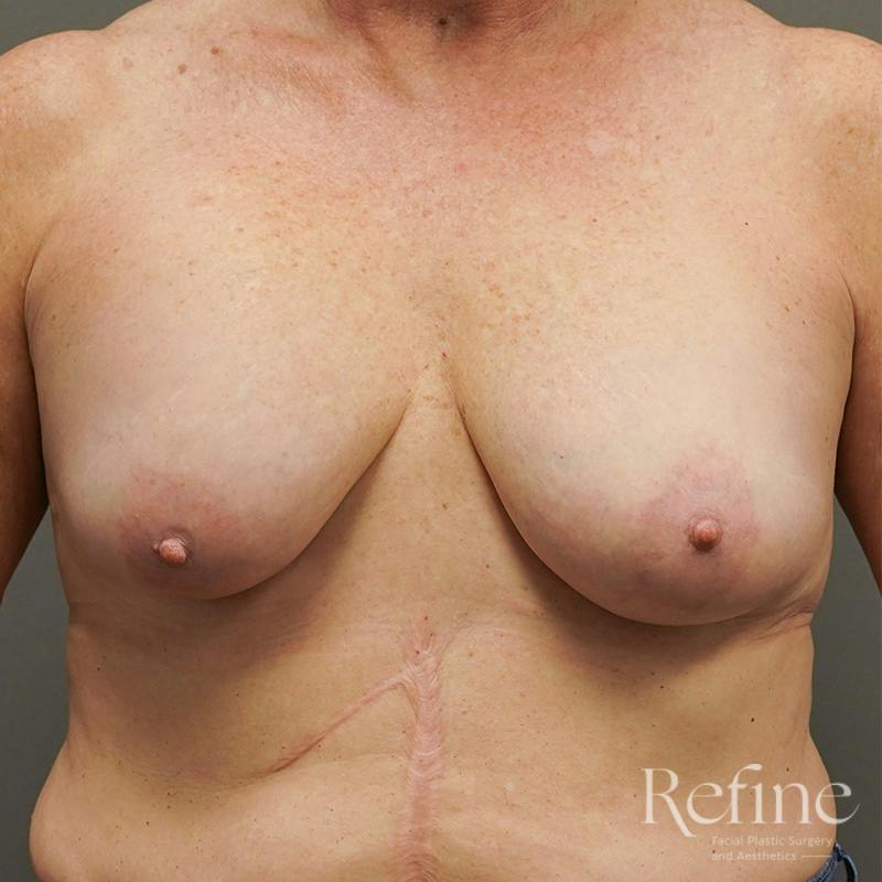 Breast Augmentation Revision Before & After Gallery - Patient 126364 - Image 1