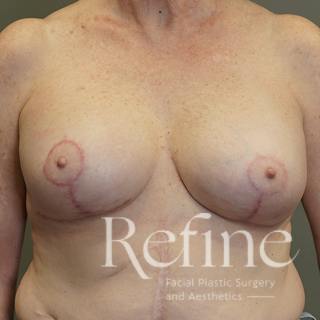 Breast Augmentation Revision Before & After Gallery - Patient 126364 - Image 2