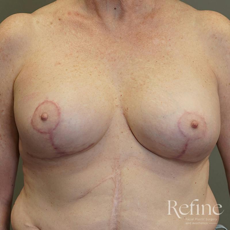 Breast Augmentation Revision Before & After Gallery - Patient 126364 - Image 2