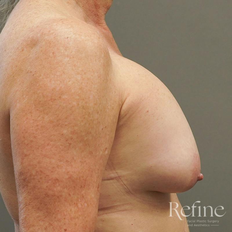 Breast Augmentation Revision Before & After Gallery - Patient 126364 - Image 5