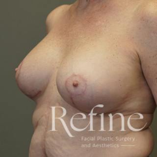 Breast Augmentation Revision Before & After Gallery - Patient 126364 - Image 8