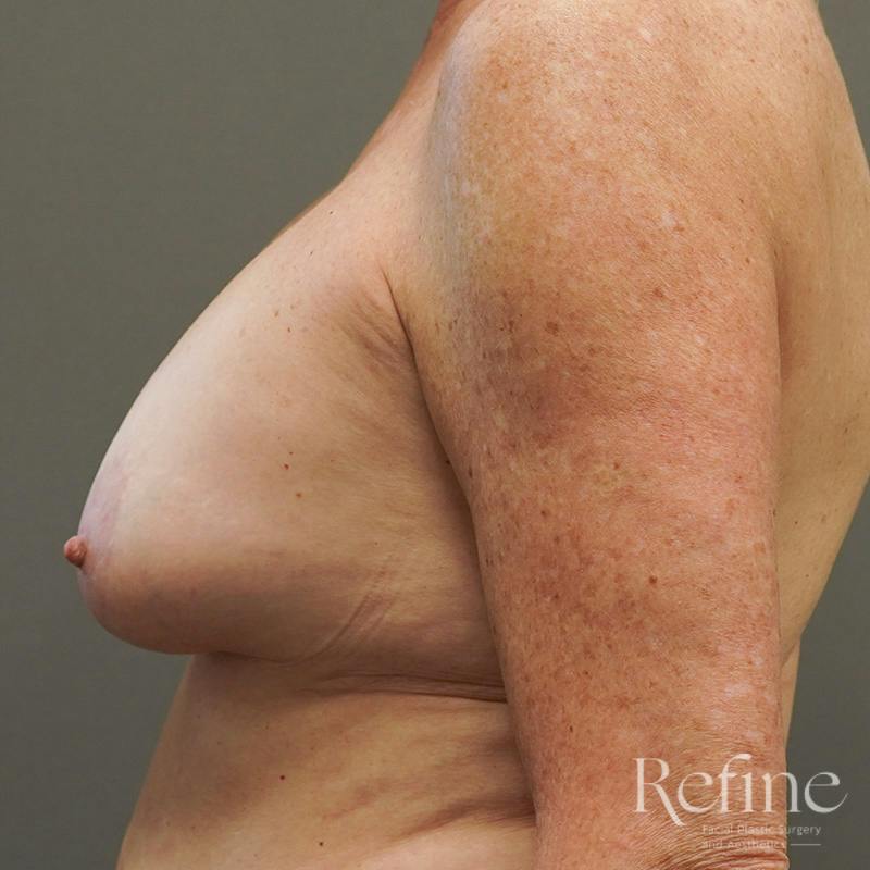 Breast Augmentation Revision Before & After Gallery - Patient 126364 - Image 9