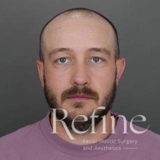 Male Rhinoplasty Before & After Gallery - Patient 229586 - Image 6