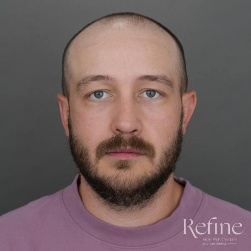 Male Rhinoplasty Before & After Gallery - Patient 229586 - Image 6