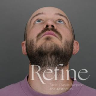 Male Rhinoplasty Before & After Gallery - Patient 229586 - Image 8