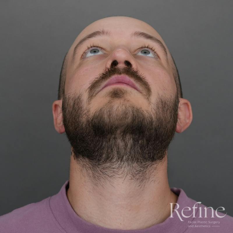Male Rhinoplasty Before & After Gallery - Patient 229586 - Image 8