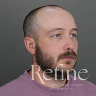 Male Rhinoplasty Before & After Gallery - Patient 229586 - Image 4