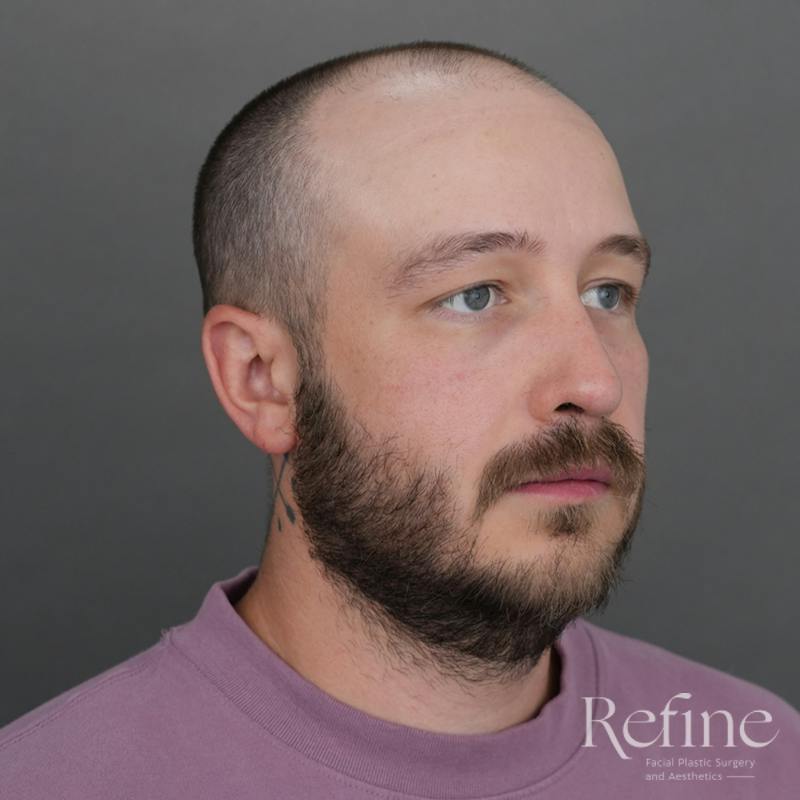 Male Rhinoplasty Before & After Gallery - Patient 229586 - Image 4