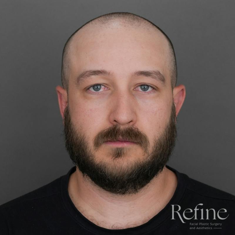 Male Rhinoplasty Before & After Gallery - Patient 229586 - Image 5