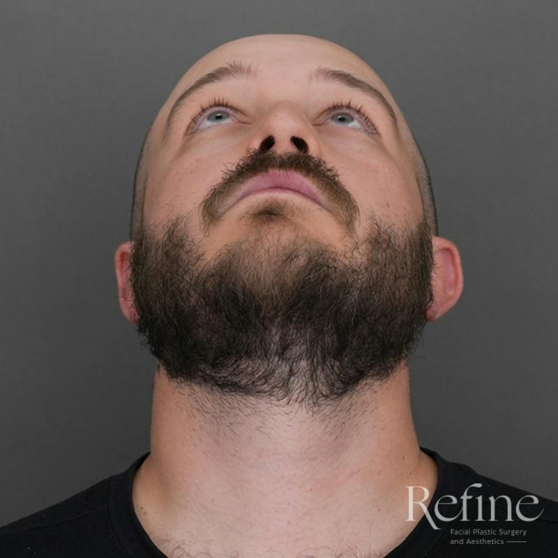 Male Rhinoplasty Before & After Gallery - Patient 229586 - Image 7