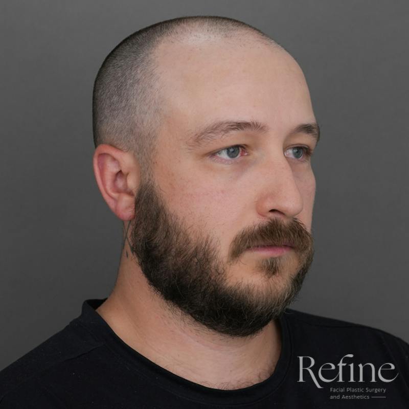 Male Rhinoplasty Before & After Gallery - Patient 229586 - Image 3