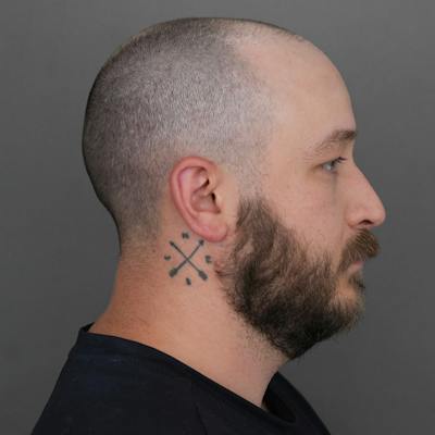 Male Rhinoplasty Before & After Gallery - Patient 229586 - Image 1