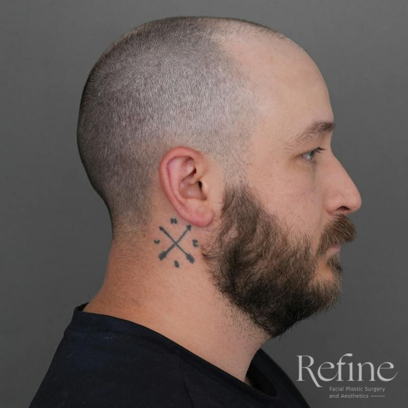 Male Rhinoplasty Before & After Gallery - Patient 229586 - Image 1