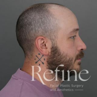 Male Rhinoplasty Before & After Gallery - Patient 229586 - Image 2