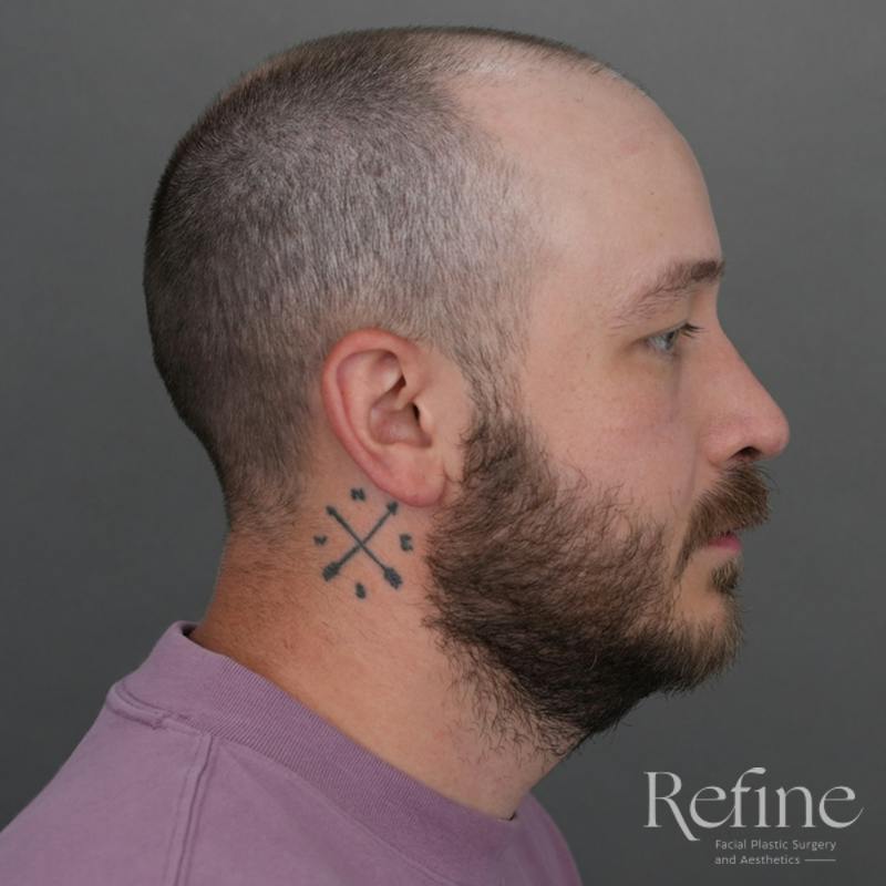 Male Rhinoplasty Before & After Gallery - Patient 229586 - Image 2