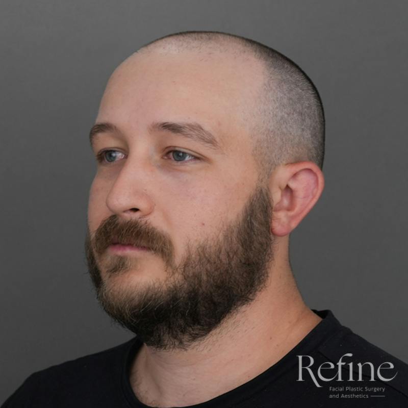 Male Rhinoplasty Before & After Gallery - Patient 229586 - Image 9