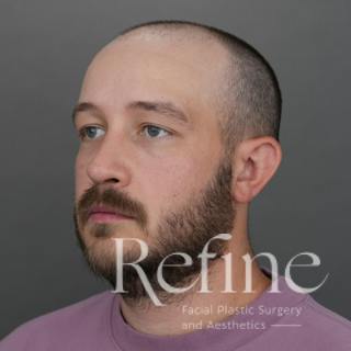Male Rhinoplasty Before & After Gallery - Patient 229586 - Image 10
