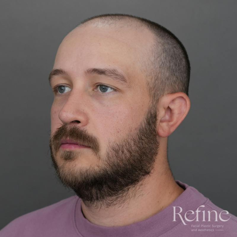 Male Rhinoplasty Before & After Gallery - Patient 229586 - Image 10
