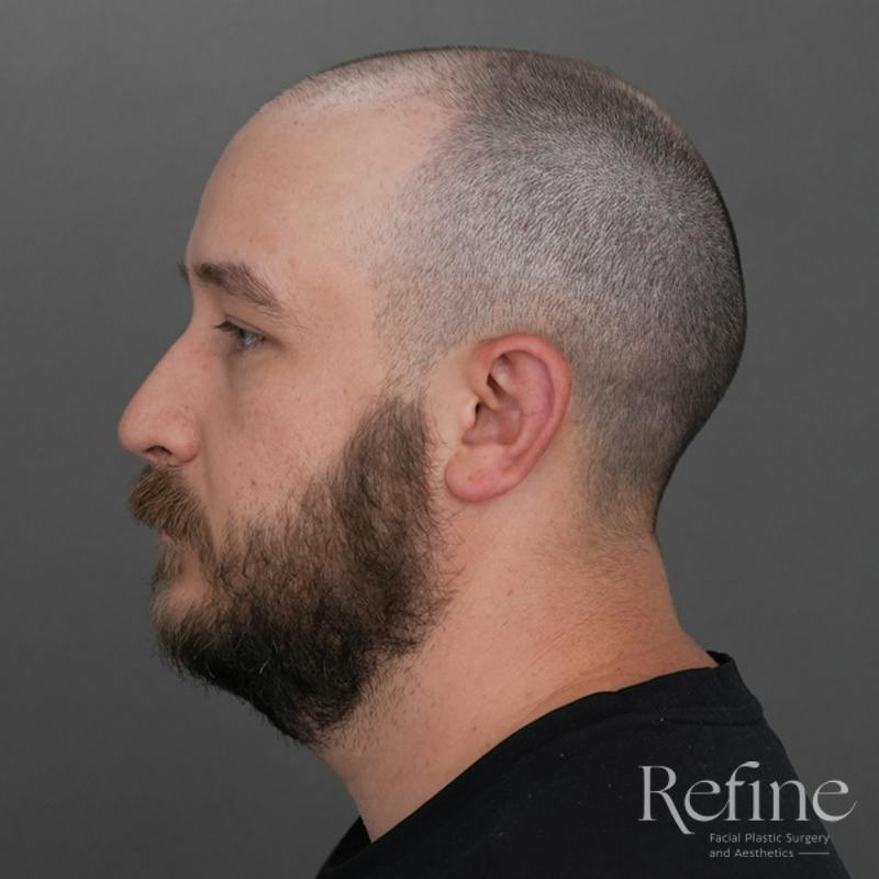 Male Rhinoplasty Before & After Gallery - Patient 229586 - Image 11