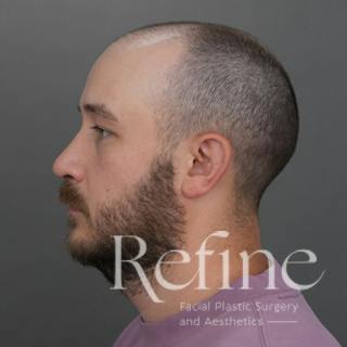 Male Rhinoplasty Before & After Gallery - Patient 229586 - Image 12