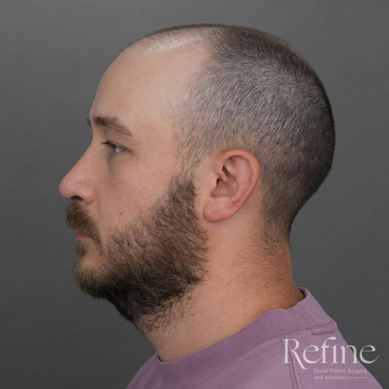 Male Rhinoplasty Before & After Gallery - Patient 229586 - Image 12