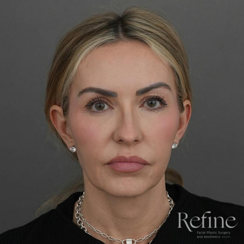 Deep Plane Facelift Before & After Gallery - Patient 165379 - Image 5