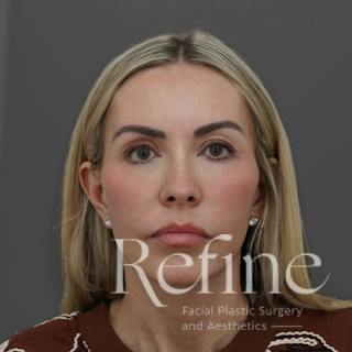 Deep Plane Facelift Before & After Gallery - Patient 165379 - Image 6