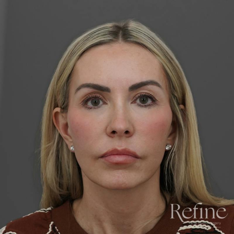 Deep Plane Facelift Before & After Gallery - Patient 165379 - Image 6