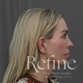 Deep Plane Facelift Before & After Gallery - Patient 165379 - Image 2