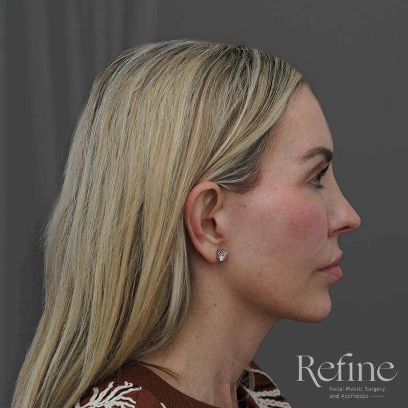Deep Plane Facelift Before & After Gallery - Patient 165379 - Image 2