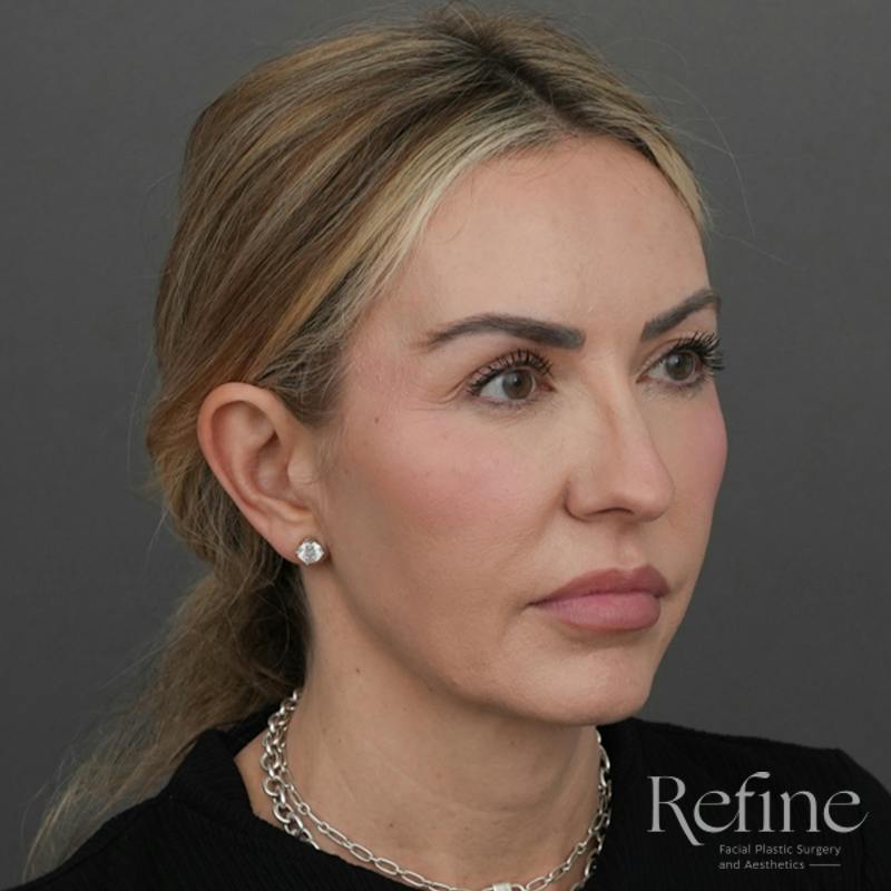 Deep Plane Facelift Before & After Gallery - Patient 165379 - Image 3