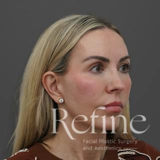 Deep Plane Facelift Before & After Gallery - Patient 165379 - Image 4