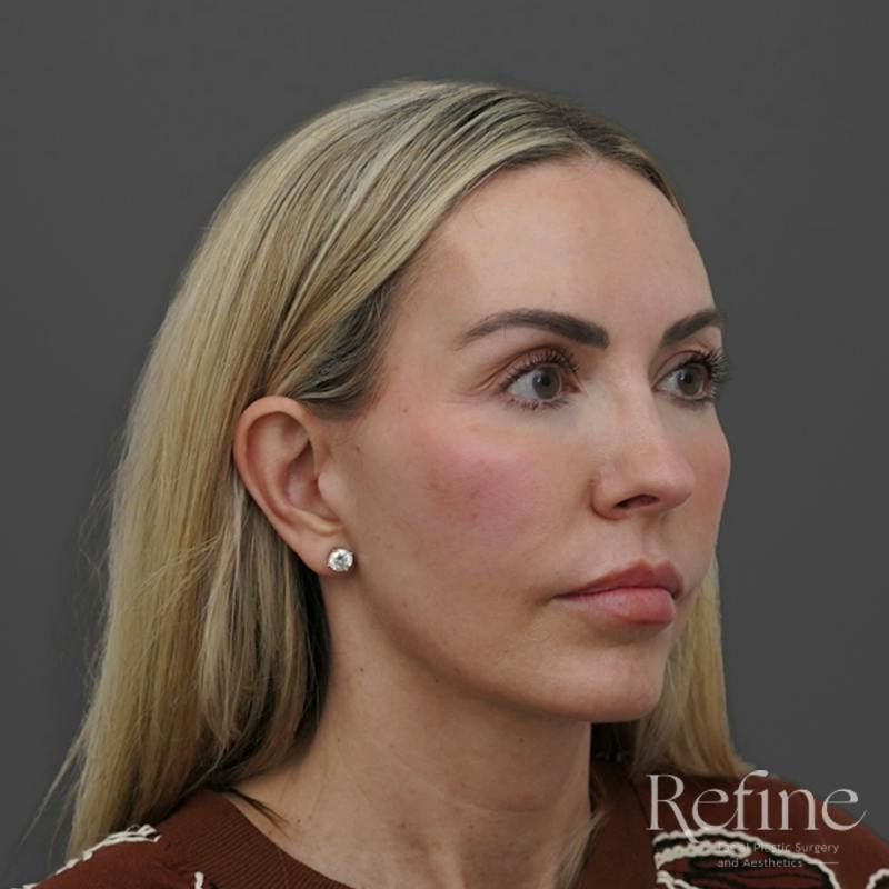 Deep Plane Facelift Before & After Gallery - Patient 165379 - Image 4