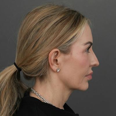 Deep Plane Facelift Before & After Gallery - Patient 165379 - Image 1