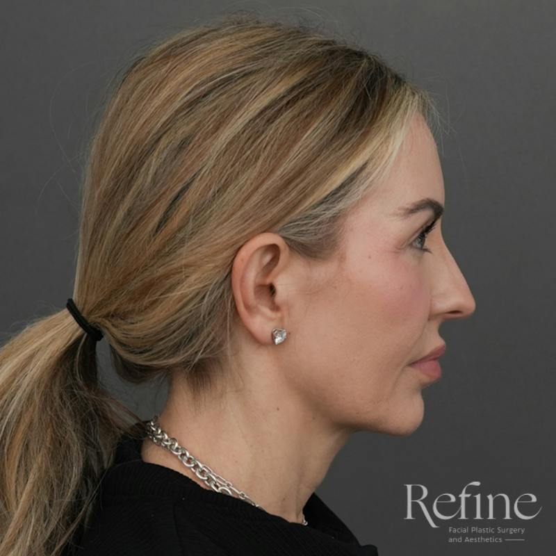 Deep Plane Facelift Before & After Gallery - Patient 165379 - Image 1