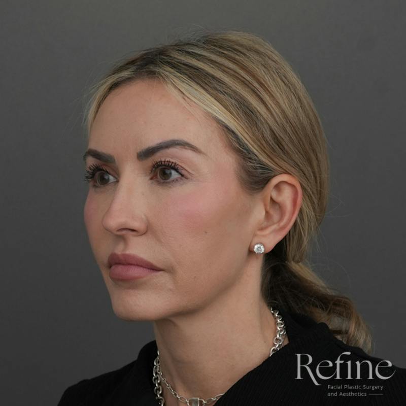 Deep Plane Facelift Before & After Gallery - Patient 165379 - Image 7