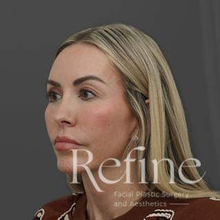 Deep Plane Facelift Before & After Gallery - Patient 165379 - Image 8