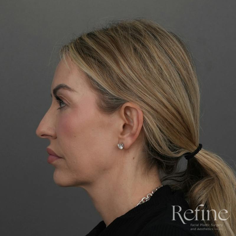 Deep Plane Facelift Before & After Gallery - Patient 165379 - Image 9