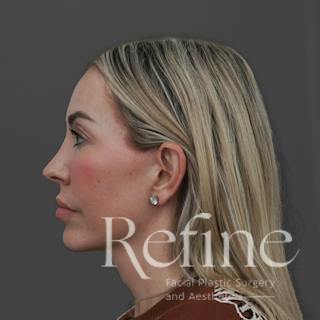 Deep Plane Facelift Before & After Gallery - Patient 165379 - Image 10