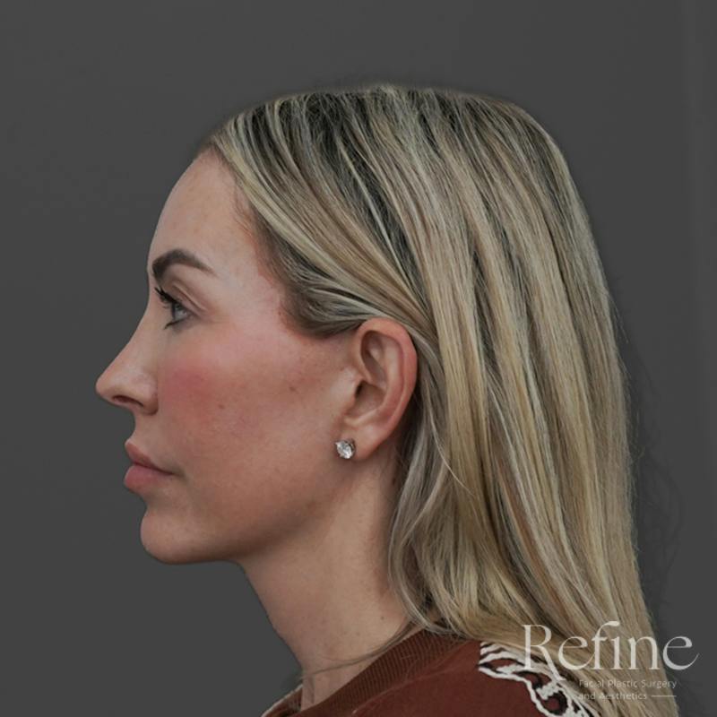 Deep Plane Facelift Before & After Gallery - Patient 165379 - Image 10