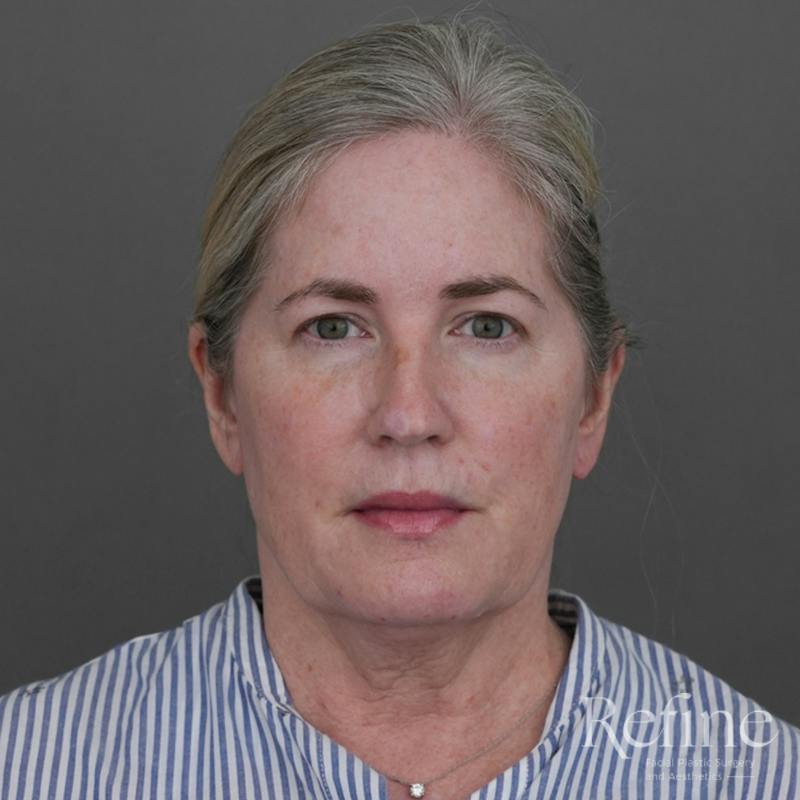 Deep Neck Lift Before & After Gallery - Patient 420466 - Image 5