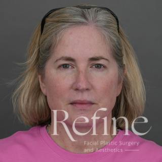 Deep Neck Lift Before & After Gallery - Patient 420466 - Image 6