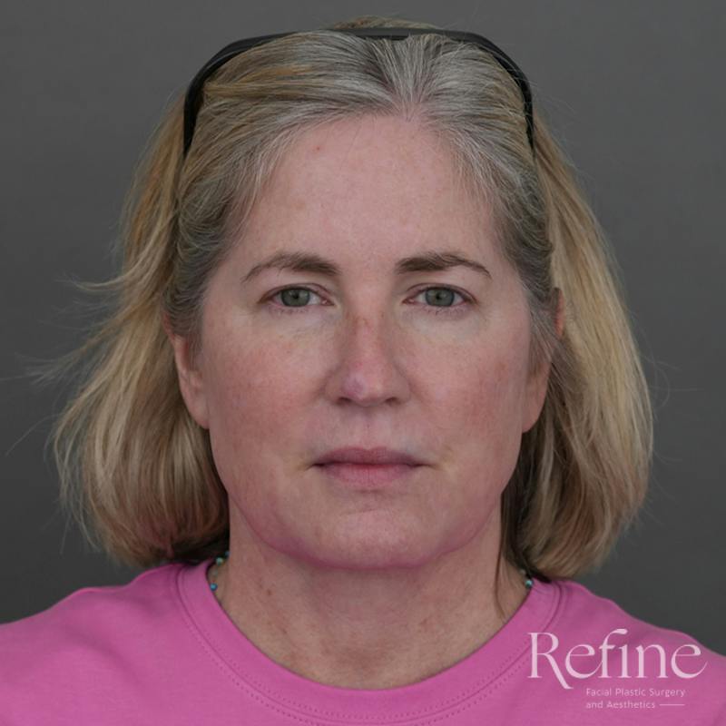 Deep Neck Lift Before & After Gallery - Patient 420466 - Image 6