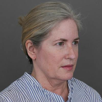 Jawline Surgery Before & After Gallery - Patient 201124 - Image 1