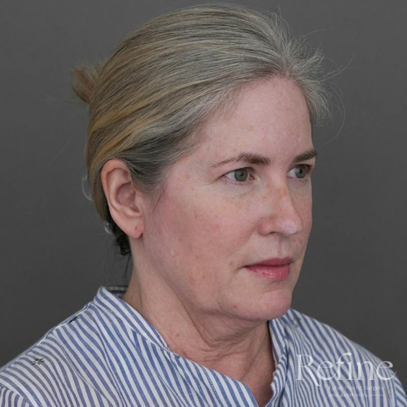 Deep Neck Lift Before & After Gallery - Patient 420466 - Image 3