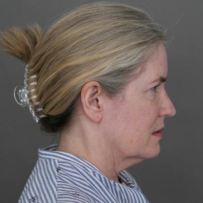 Deep Neck Lift Before & After Gallery - Patient 420466 - Image 1