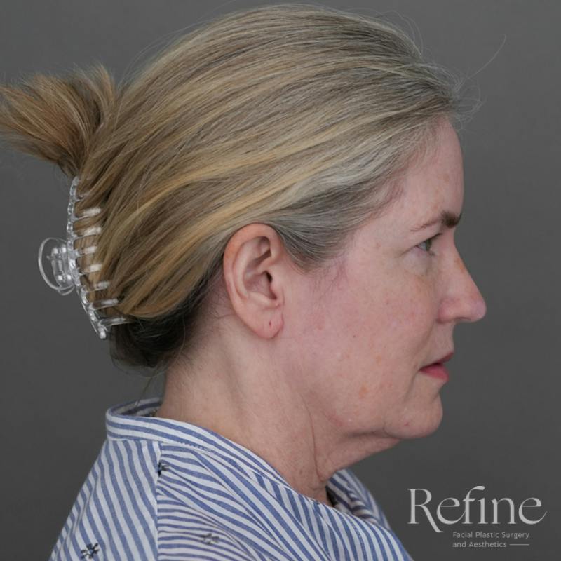 Deep Neck Lift Before & After Gallery - Patient 420466 - Image 1